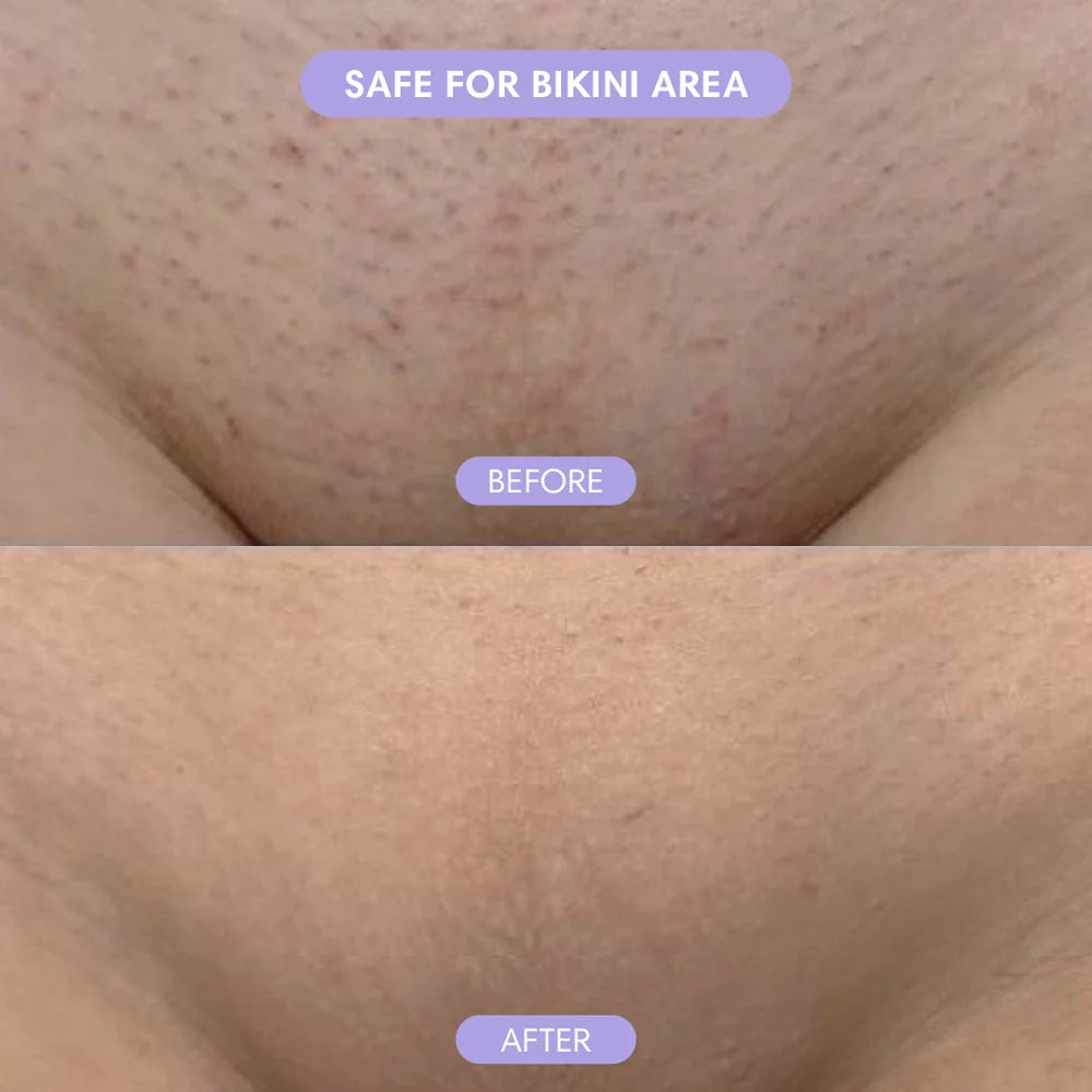 SilkGleam™ – Silky smooth skin, no bumps, no burns.